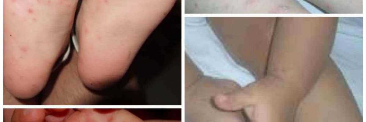 EL AYAK AĞIZ HASTALIĞI