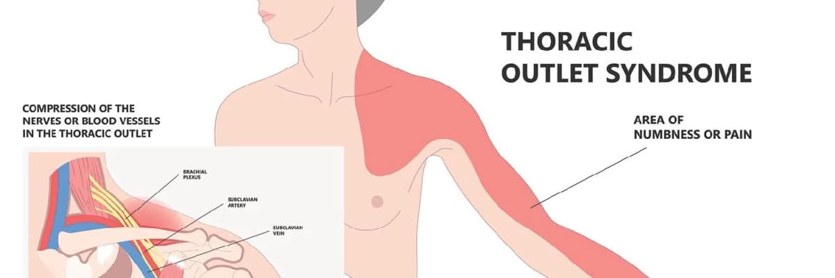 Thorasik Outlet Sendromu ve Boyun Sırt ve Kol ağrısı