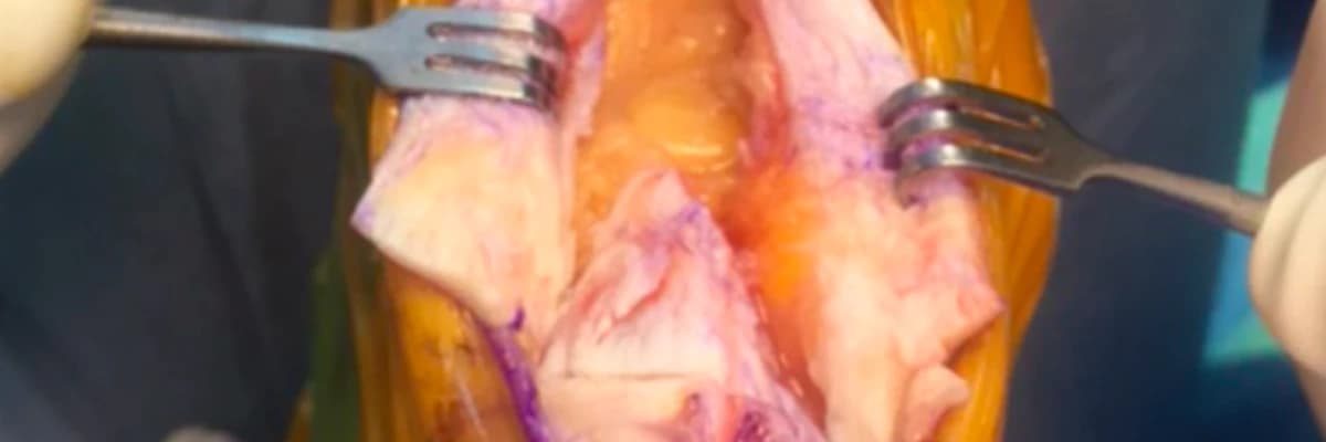 Achilles tendon-splitting approach and double-row suture anchor repair for Haglund syndrome