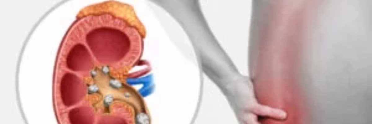 Böbrek Taşı Nedir?