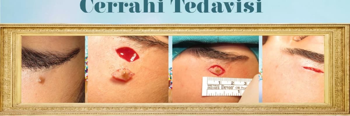 Cerrahi Tedavi Gerektiren Deri Lezyonları