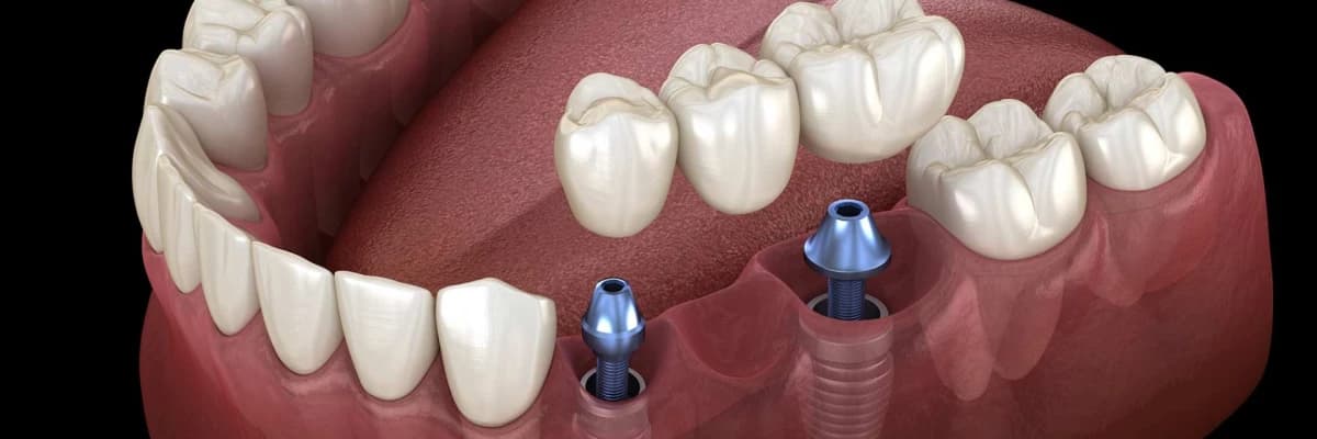 İmplant Uygulamasından Sonra Dikkat Edilmesi Gerekenler