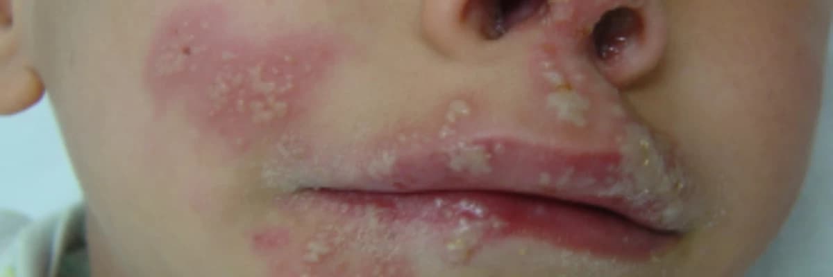 HERPES VİRÜS ENFEKSİYONLARI