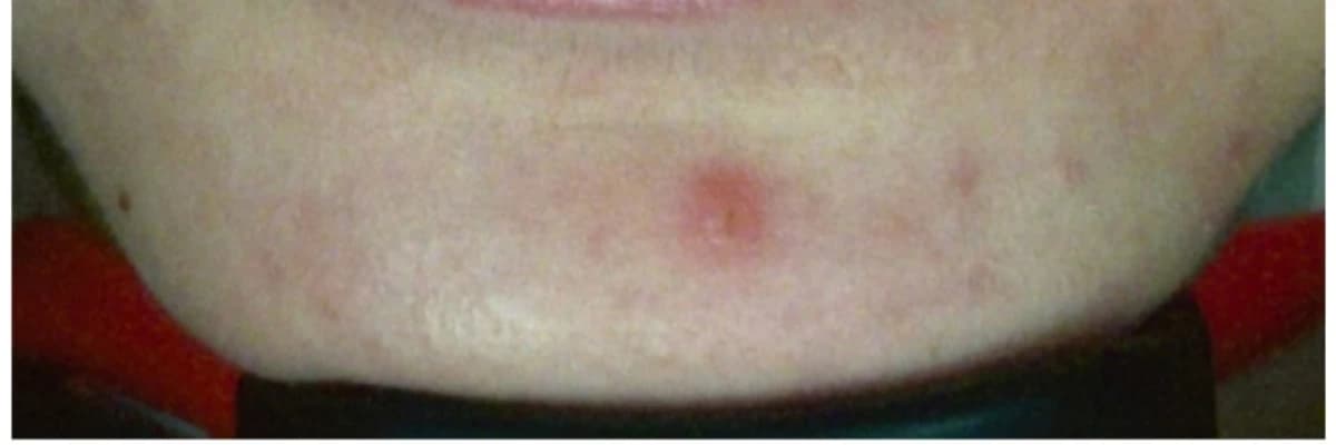 ANGÜLER KEİLİT (PERLEŞ)