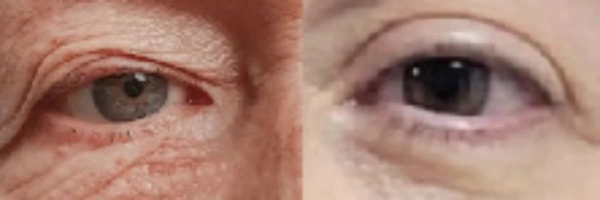 Blefaroplasti Nedir?