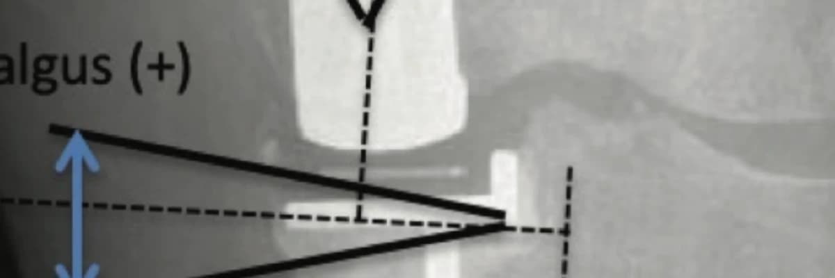 Oxford Unicondylar Knee Arthroplasty Hybrid and Cementless Fixation: Is There Any Difference in Short-term Follow-up?