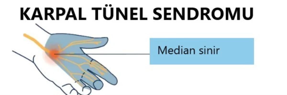 KARPAL TÜNEL SENDROMU, KTS