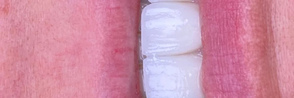 Minimal Diş Kesimi ve Lamine Porselen Kaplamalar: Estetik İyileştirmelerde Yenilikçi Bir Yaklaşım