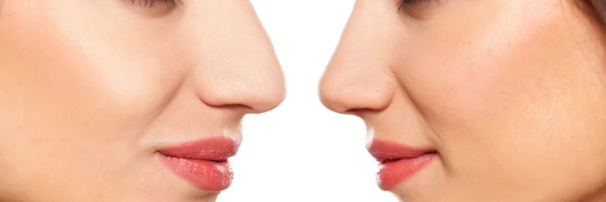 Koruyucu Rinoplasti (Preservation Rhinoplasty) Nedir?