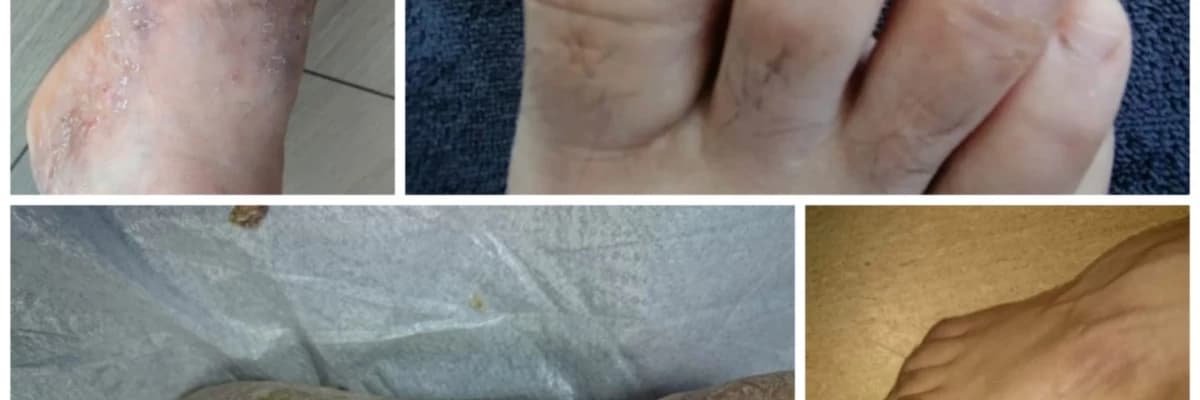 TİNEA PEDİS yani AYAK MANTARI