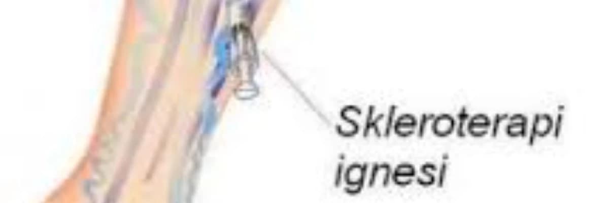 Varis Tedavisinde Hangi Yöntem Kullanılıyor?