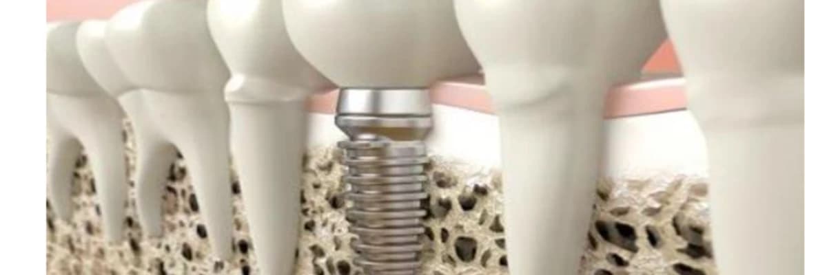 İmplant Diş Tedavisi Nedir?