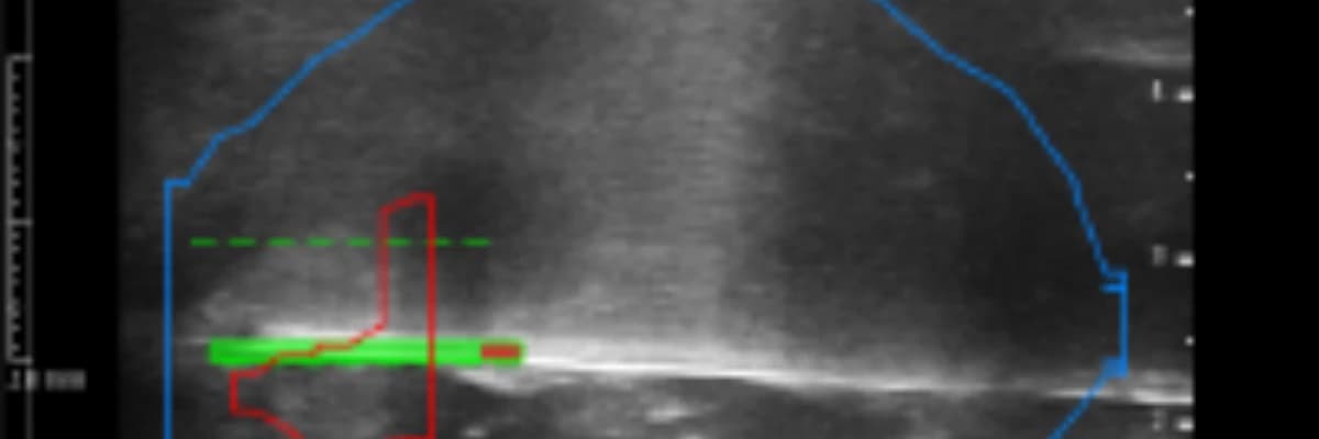 PROSTAT FÜZYON BİYOPSİ