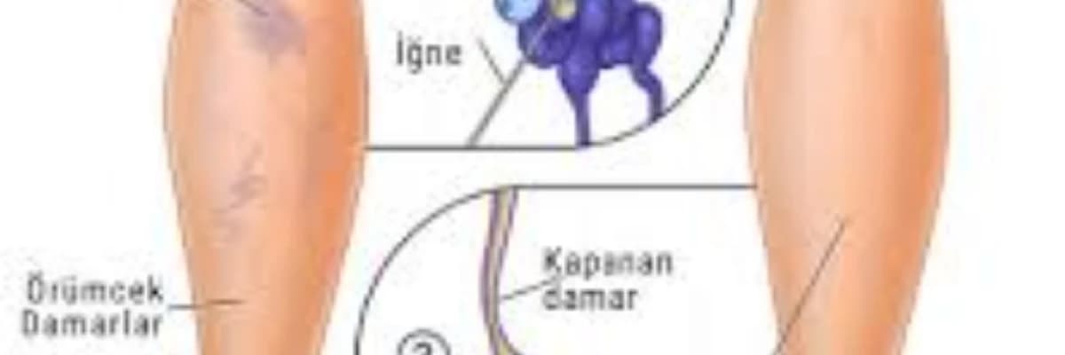 Skleroterapi tedavisi sonrası dikkat edilmesi gerekenler!!!