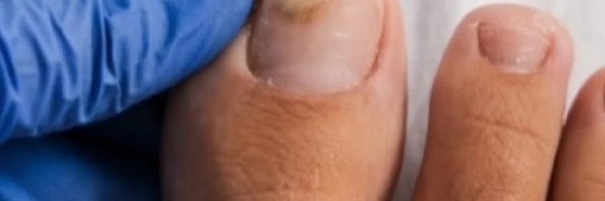 Tırnak Boşalması (Onikoliz) Nedir? Neden Olur ve Nasıl Çözülür? 🦶✨