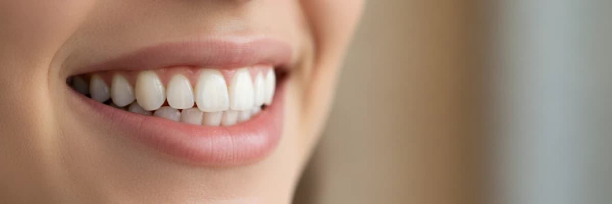 Porselen Lamina Nedir?
