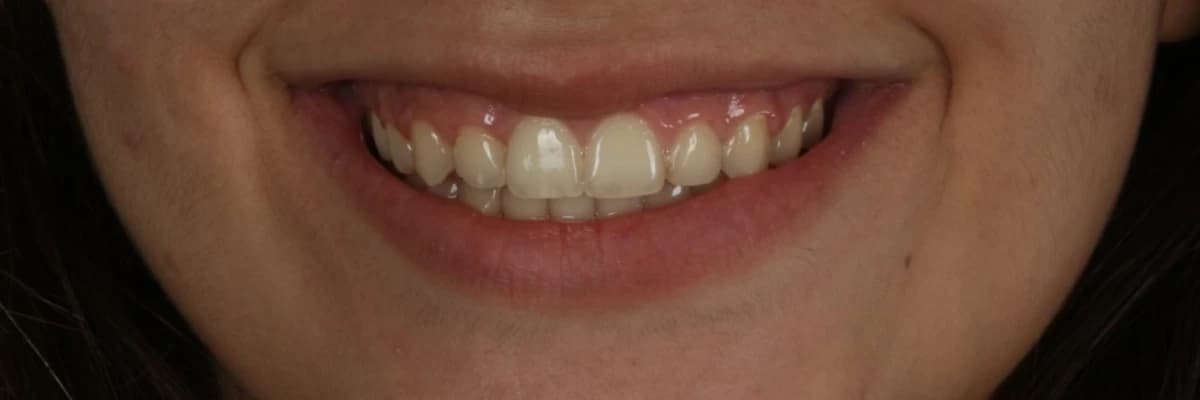 Ortodonti tedavisinden sonra dişlerin sallanması normal midir?