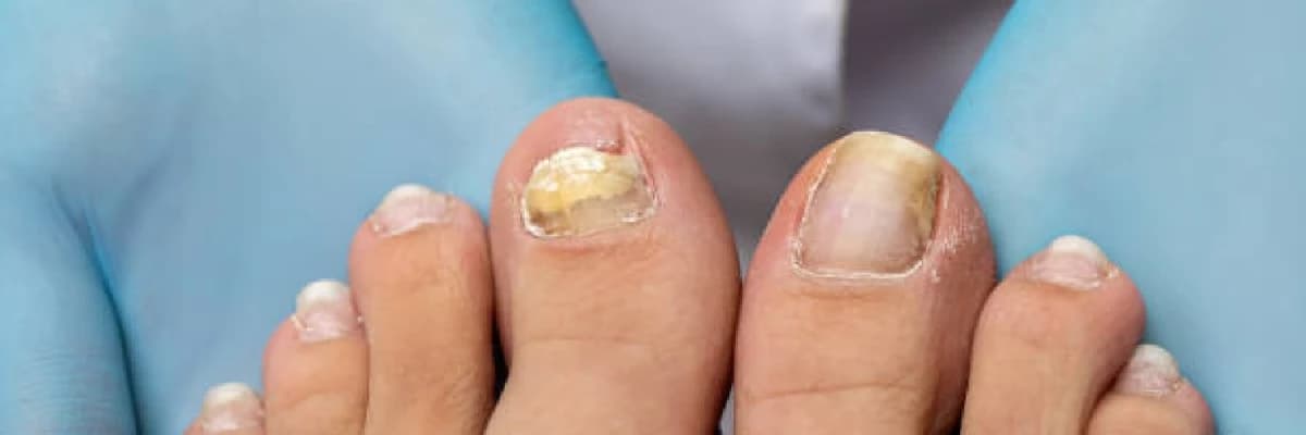 Ayak Tırnağı Neden Etten Ayrılır? 😳💅 Tırnak Düşecek mi?