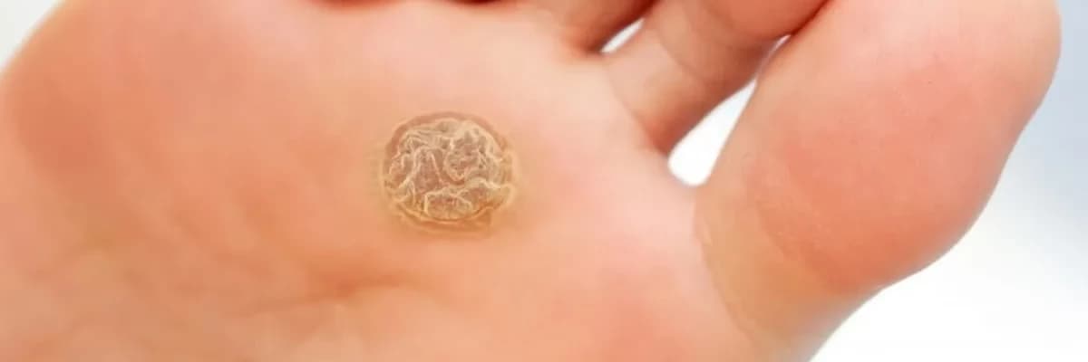 Nasır Neden Sürekli Aynı Yerde Çıkıyor? 😳🦶 Nasırı Aldırıyorum, Yine Çıkıyor!