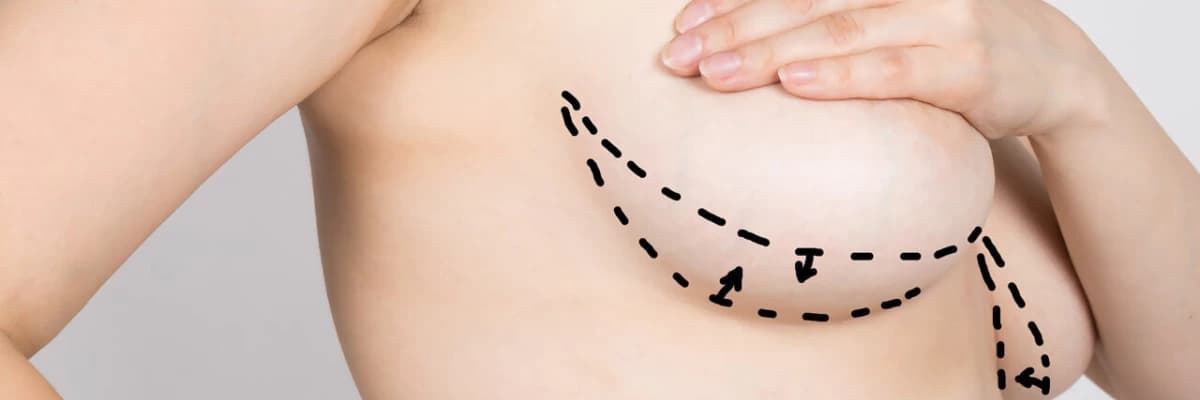 Meme Küçültme Ameliyatı Nedir? Soru-Cevap