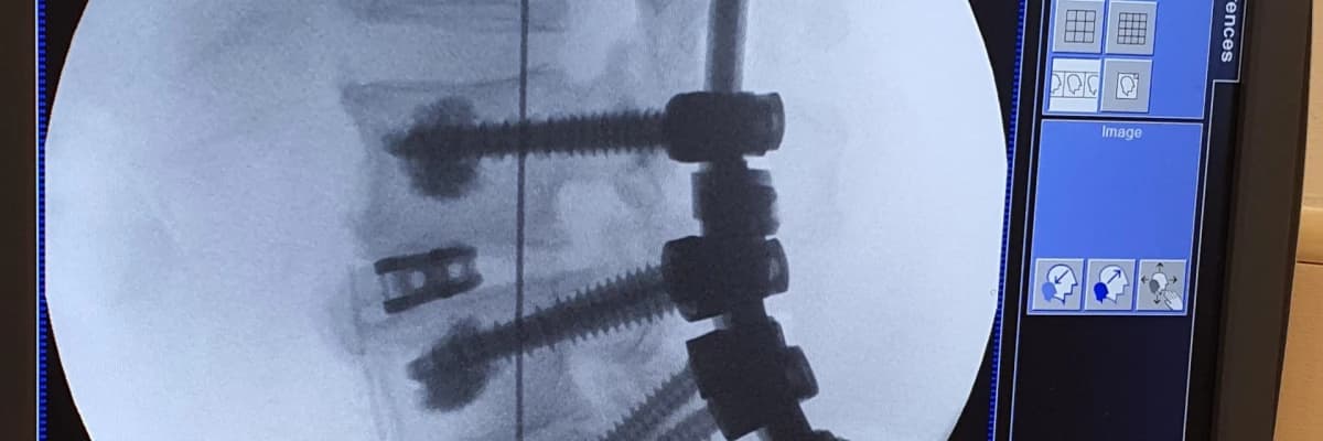 Vidalı Omurga Ameliyatı nedir? Spinal Enstrümantasyon ve Spinal Füzyon Nedir?