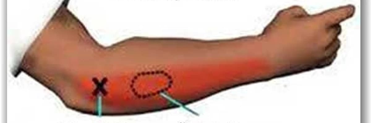 TENİSCİ DİRSEĞİ