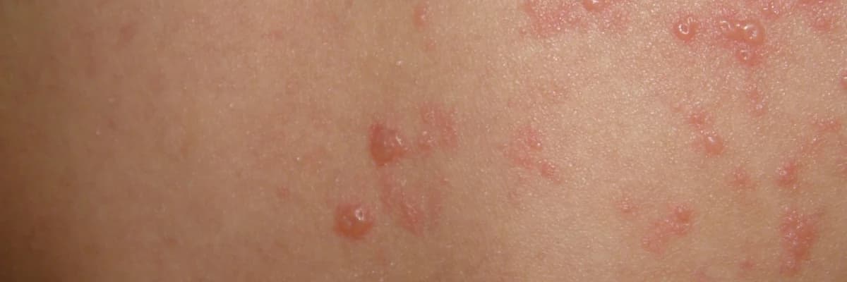 HERPES ZOSTER, ZONA VEYA HALK DİLİNDE GECE YANIĞI
