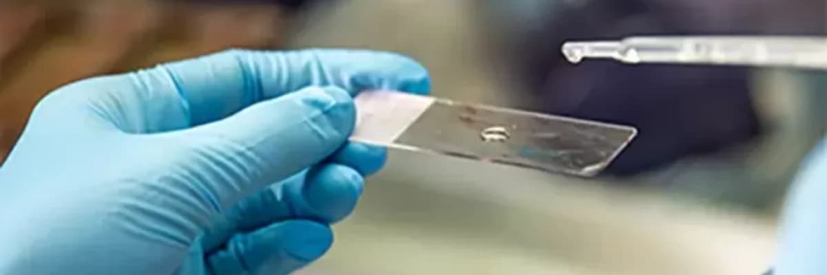 SMEAR TESTİNDE ASCUS  ÇIKMASI