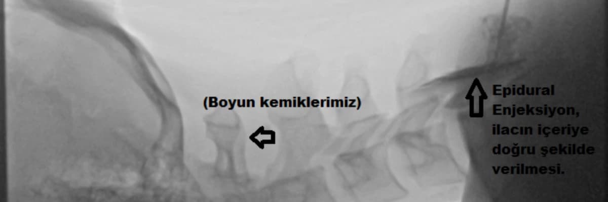 Ameliyatsız Boyun Fıtığı Tedavisi