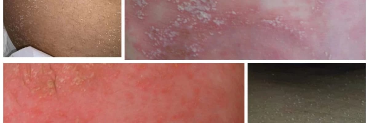 Miliaria yani İSİLİK