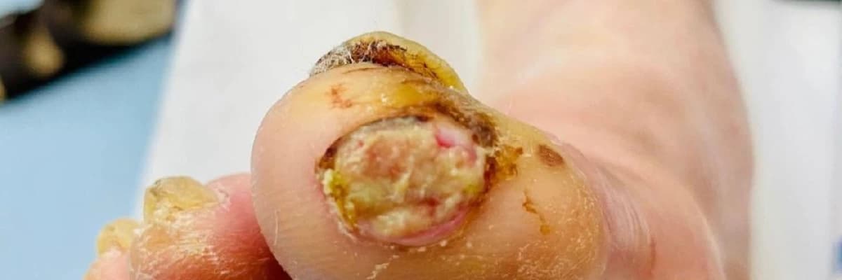 Ayak Yaralarında Enfeksiyon Belirtileri Nelerdir? Ne Zaman Tehlikeli Hale Gelir?