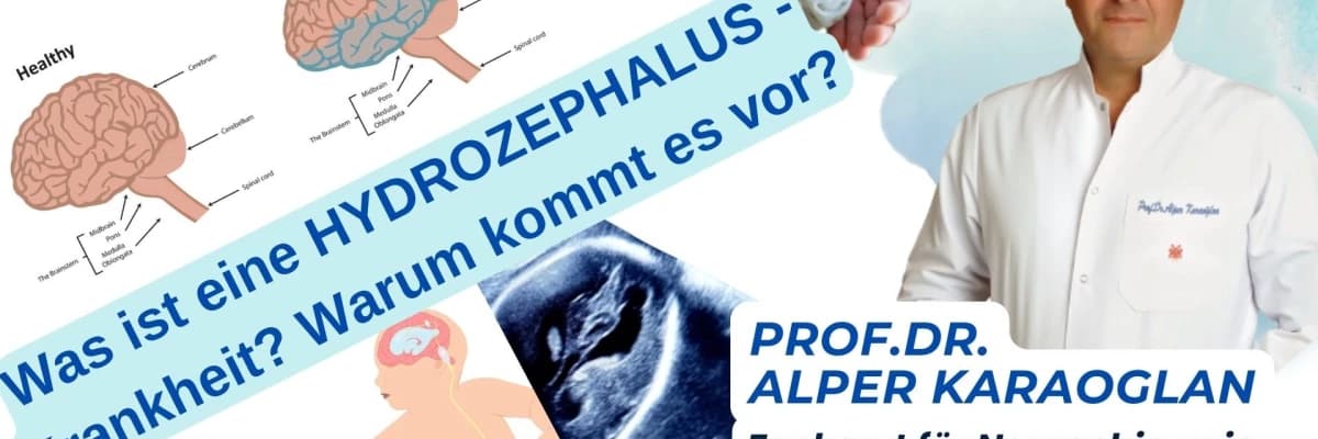 Was ist eine HYDROZEPHALUS-Krankheit? Warum kommt es vor?