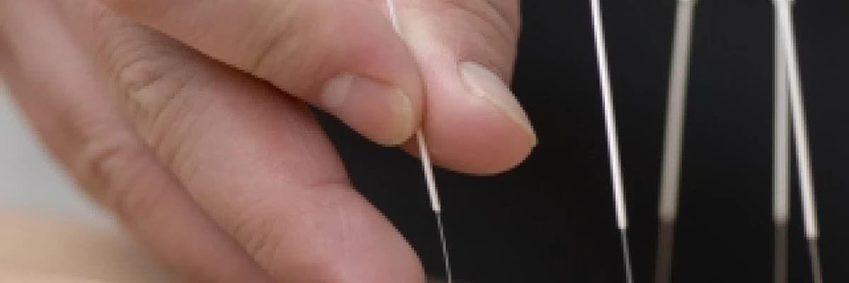 Akupunktur tedavisi nedir?