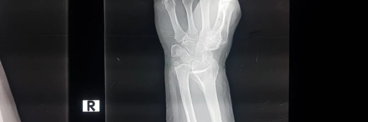 EL BİLEK BÖLGESİ KIRIKLARI