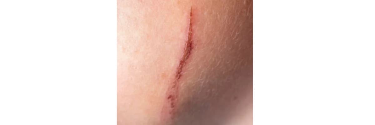 Yara İzi Tedavisi (Skar Revizyonu)
