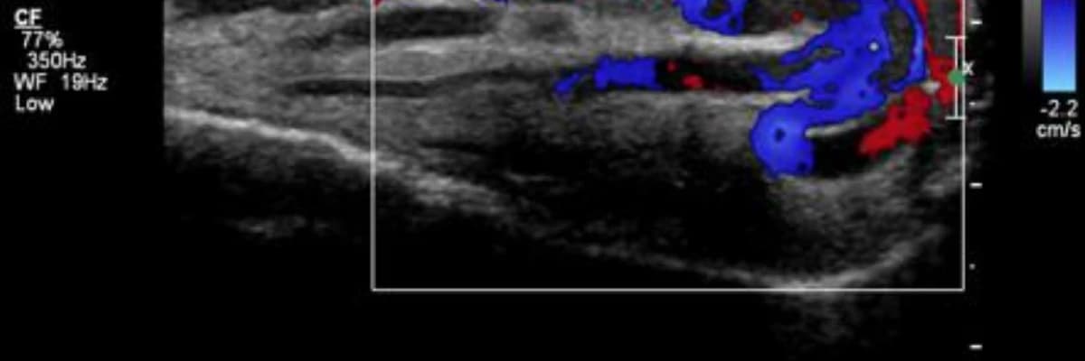 Varikosel nasıl teşhis ve tedavi edilir?