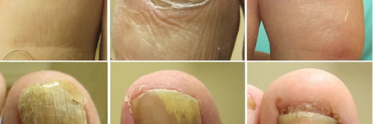 Ayak Mantarı Nedir? Belirtileri, Nedenleri ve Tedavisi