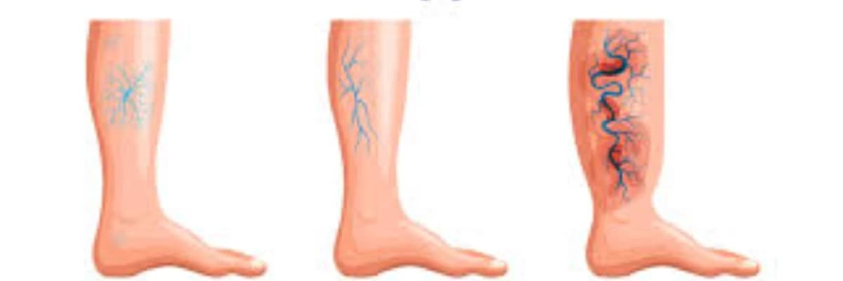 Varis Hastalığının Komplikasyonları Nelerdir??