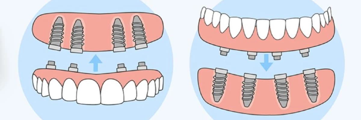 All on Four ve All on Six Tekniği