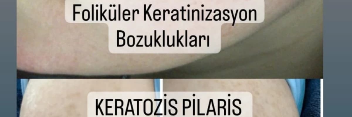 KERATOZİS PİLARİS