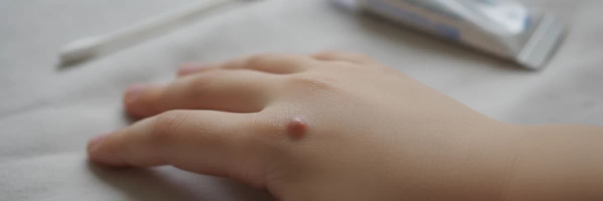 Çocuklarda Siğil Neden Olur ve Nasıl Tedavi Edilir?