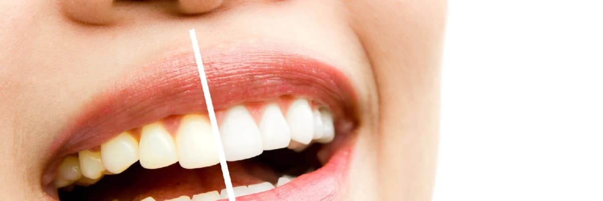 Diş Beyazlatma (Bleaching) Zararlı Mıdır ve Ne Sıklıkla Yapılmalıdır?