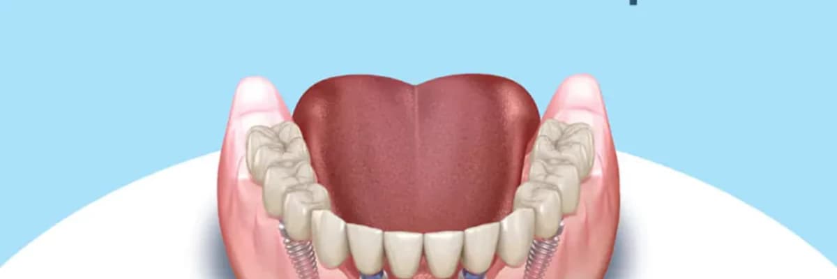 All On Four İmplant Sistemleri