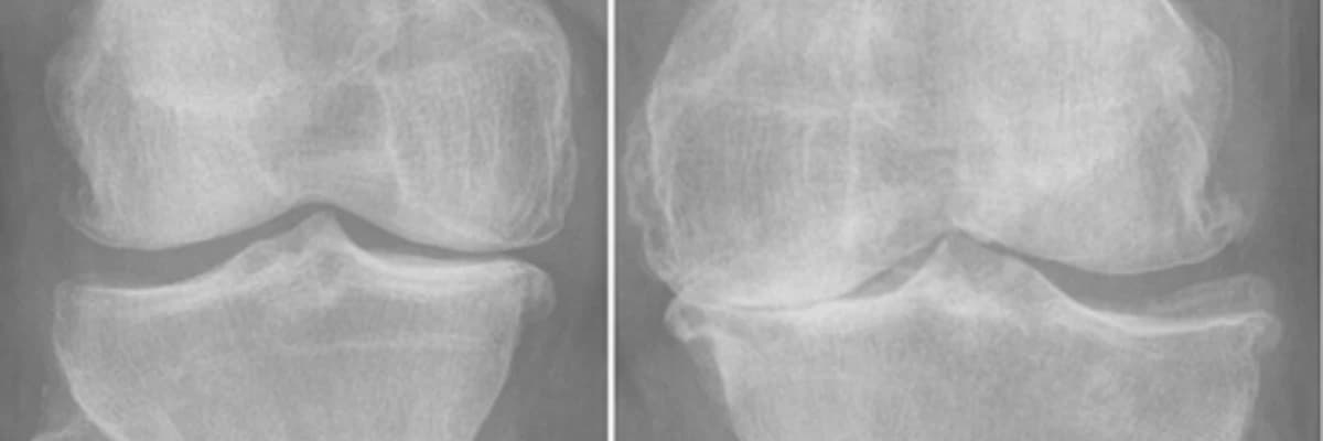 Diz Protezi Ameliyatı: Hastalar İçin Kapsamlı Bilgilendirme