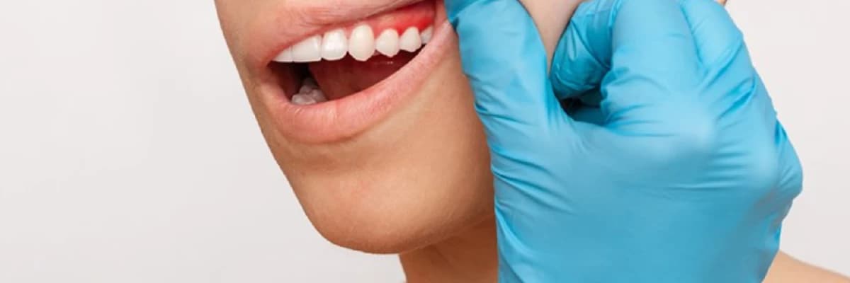 Diş Eti Hastalıkları ve Tedavisi