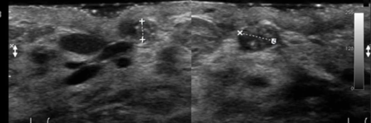 Fibroadenom ile Meme Kanseri İlişkisi