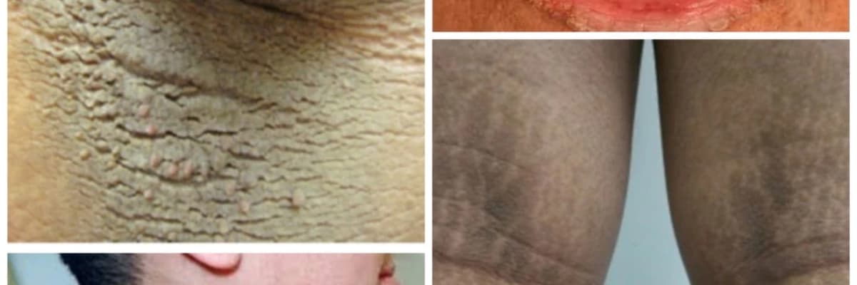 AKANTOZİS NİGRİKANS