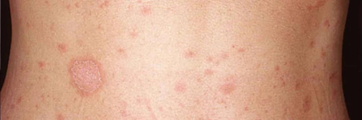 Pityriasis rosea: a natural history of pediatric cases in the Central Anatolia Region of Turkey