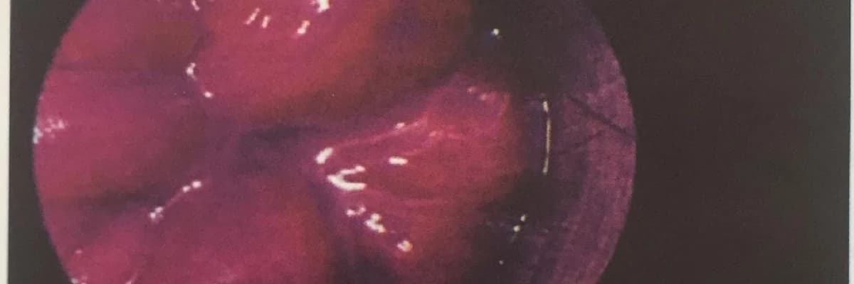 HEMOROİDAL HASTALIK