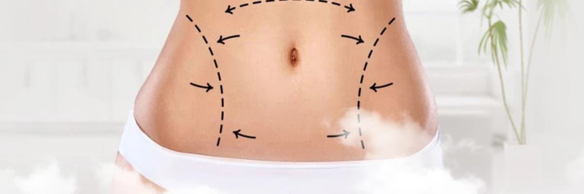 Karın Germe Ameliyatı Nasıl Olur?